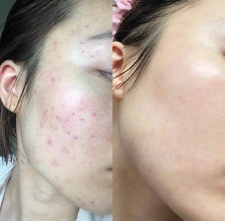  Kem dưỡng Retinol A313 của Pháp