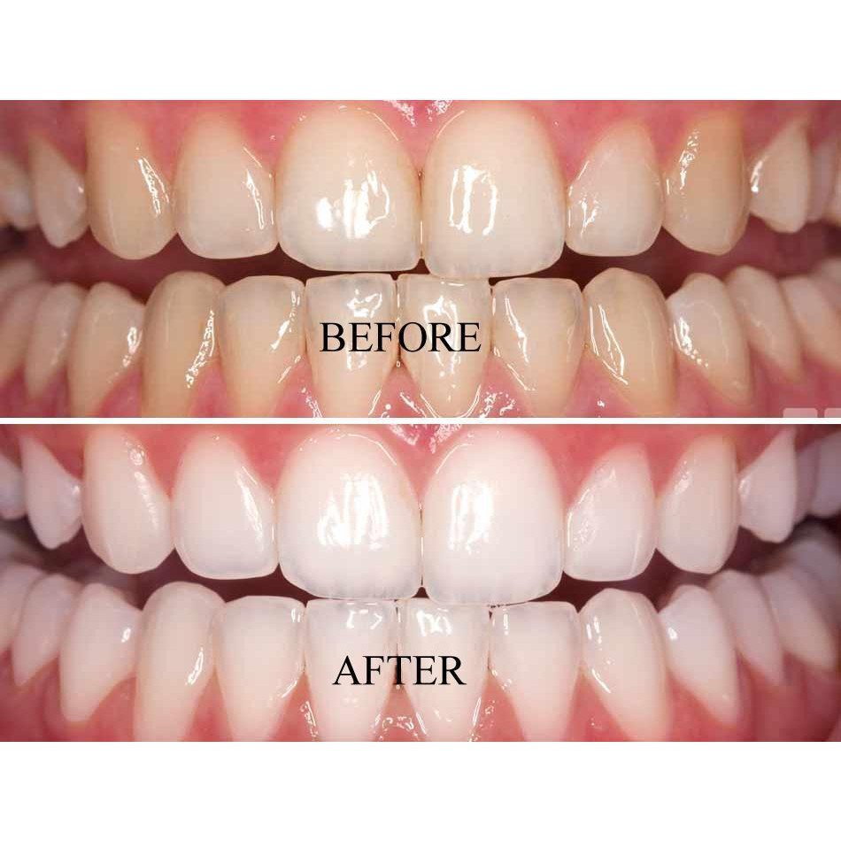 Tẩy Trắng Răng White Smile Giúp Trắng răng ngay lần đầu tiên sử dụng