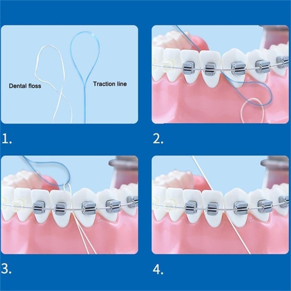 Dụng Cụ Chỉ Chỉnh Hình Cây Cầu