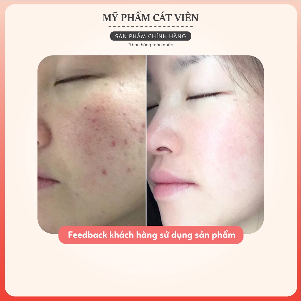 Serum mụn Derma, giảm mụn, giảm thâm,  mụn đầu đen, se khít lỗ chân lông Me'dream ACNES SERUM 50ml