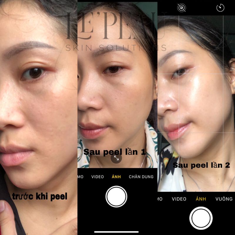Peel da Vi Tảo Retinol LE'PEAU tặng kèm serum B5 và Ance serum diếp cá ⚡ Freeship ⚡