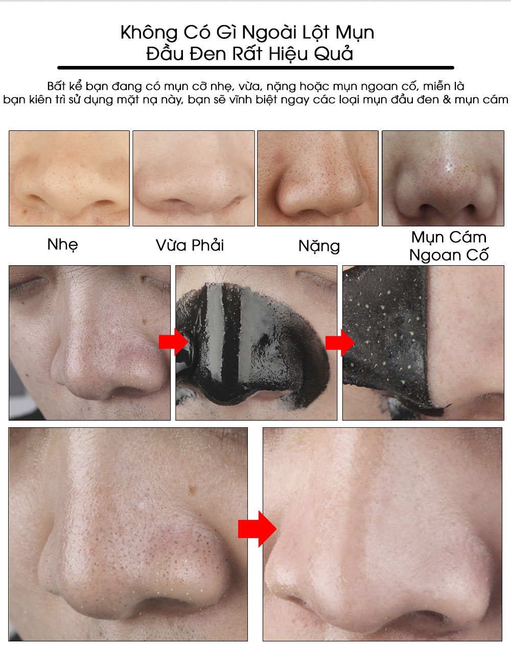 [Hàng Có Sẵn] LANBENA Chai Gel Lột Mụn Mũi, Mụn Cám & Mụn Đầu Đen 50g | BigBuy360 - bigbuy360.vn