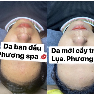 Cấy trắng spa handmade