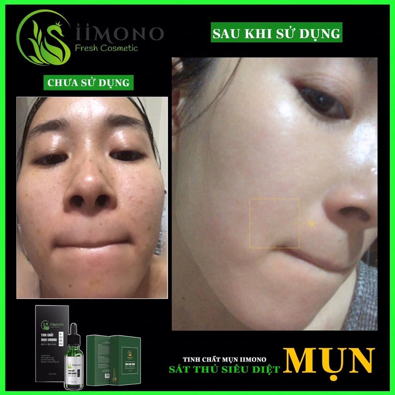 Serum tri mun Combo 2 hộp tinh chất mụn IIMONO 20ml tinh chat tri mun | BigBuy360 - bigbuy360.vn