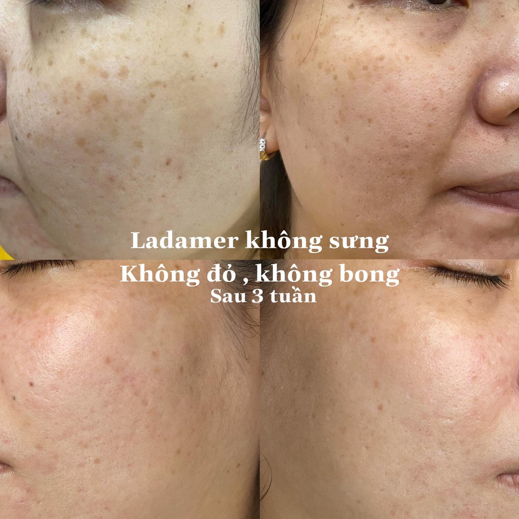 Bộ kem dưỡng trắng da giảm nám Ladamer Intensive Whitening Cream