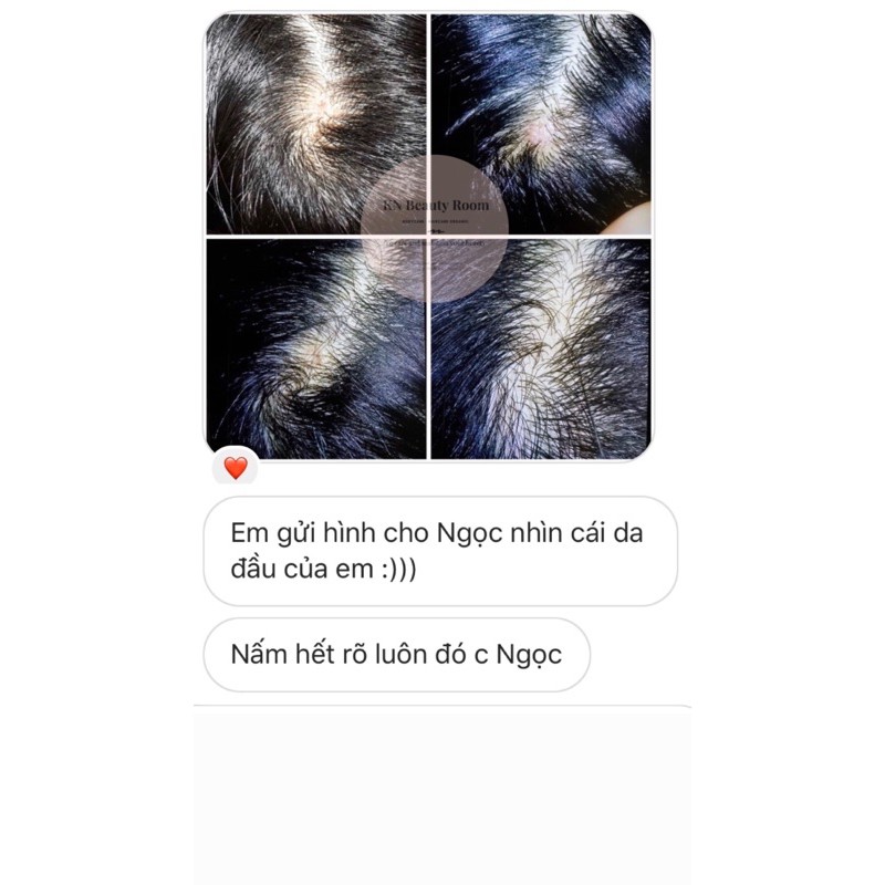 Xịt Tinh Chất Kích Mọc Tóc Giảm Rụng Trị Hói- KN Beauty Room | BigBuy360 - bigbuy360.vn