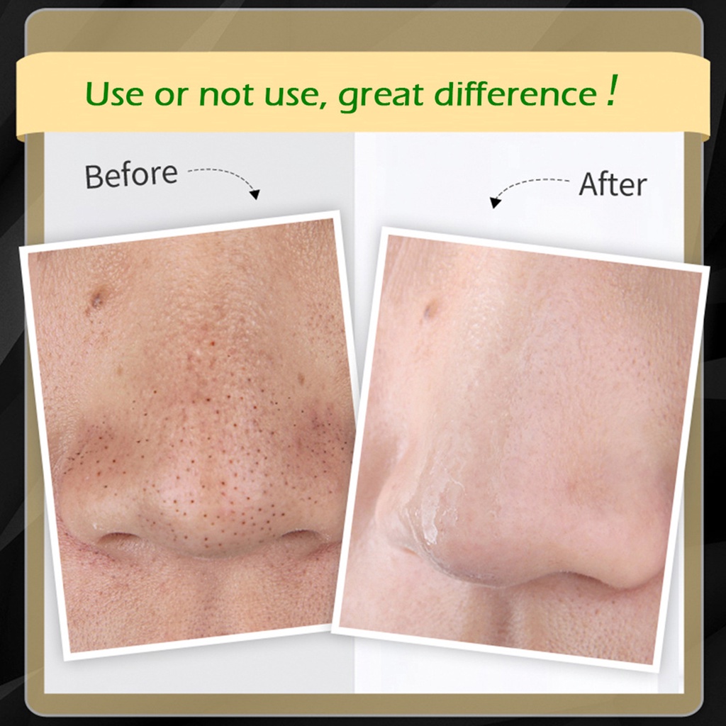 Mặt Nạ Hỗ Trợ Giảm Mụn Đầu Đen Làm Sạch Sâu Se Khít Lỗ Chân Lông Dành Cho Unisex