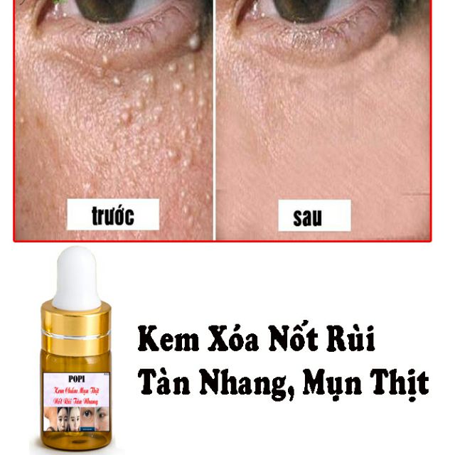 🌺Kem Xóa Nốt Ruồi
