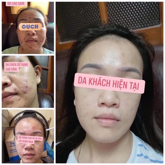 Serum mụn thảo dược Behome Spa 💕Freeship💕-  Mụn thâm, Mủ đều đánh bật sau 7 ngày | BigBuy360 - bigbuy360.vn