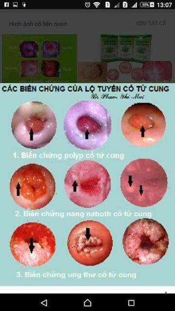 Thuốc đặt Viêm lộ tuyến Hằng Thu