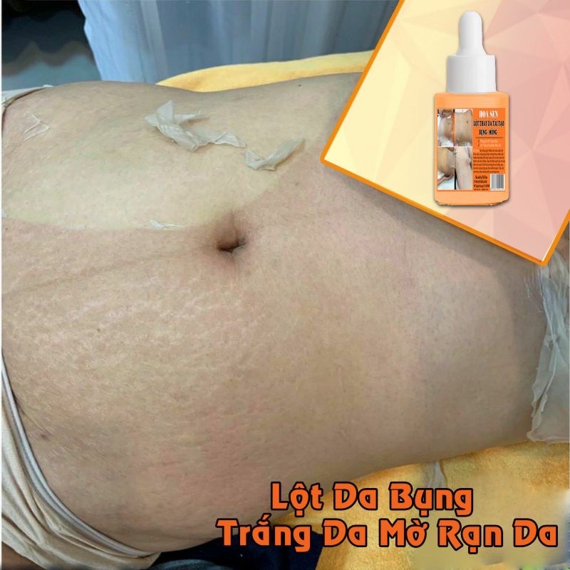 Thay Da Sinh Học Lột Mông Bụng Hết Thâm Rạn Da | BigBuy360 - bigbuy360.vn