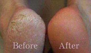 BỘ CHÀ GÓT CHÂN BIG CARE