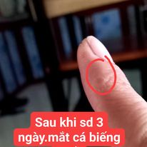 Serum Nunamin - chuyên mụn cóc , mắt cá , chai sừng