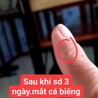 Mụn cóc , mụn thịt , mắt cá , chai chân Nunamin