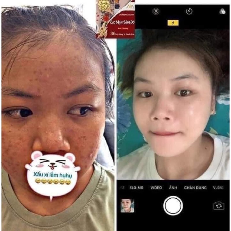 [Mã SKAMSALE8 giảm 10% đơn 200K] [CHÍNH HÃNG ]CAO MỤN SÂM ĐỎ -36vị thuốc quý | BigBuy360 - bigbuy360.vn