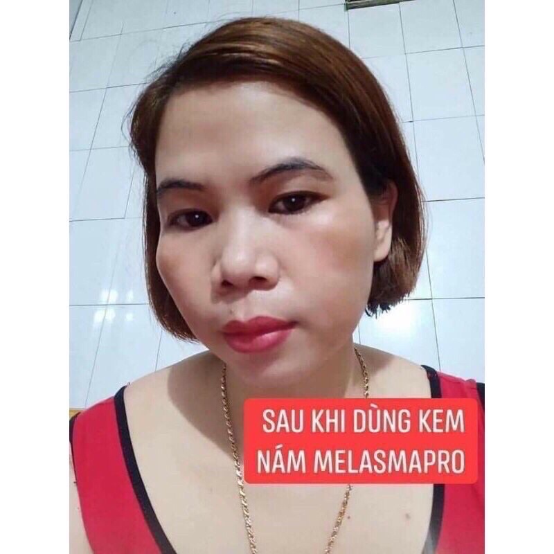 KEM NÁM PRO MELASMA PRO TRẦN KIM HUYỀN