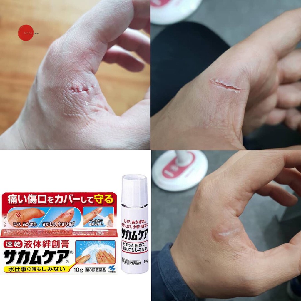 GEL BÔI LIỀN DA VẾT THƯƠNG HỞ KOBAYASHI