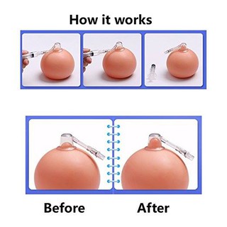Dụng cụ keo num vu tụt, ngắn, lõm hiệu quả vĩnh viễn