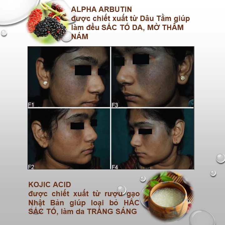 Serum trắng da mờ thâm nám 3% Alpha Arbutin 3% Kojic Acid
