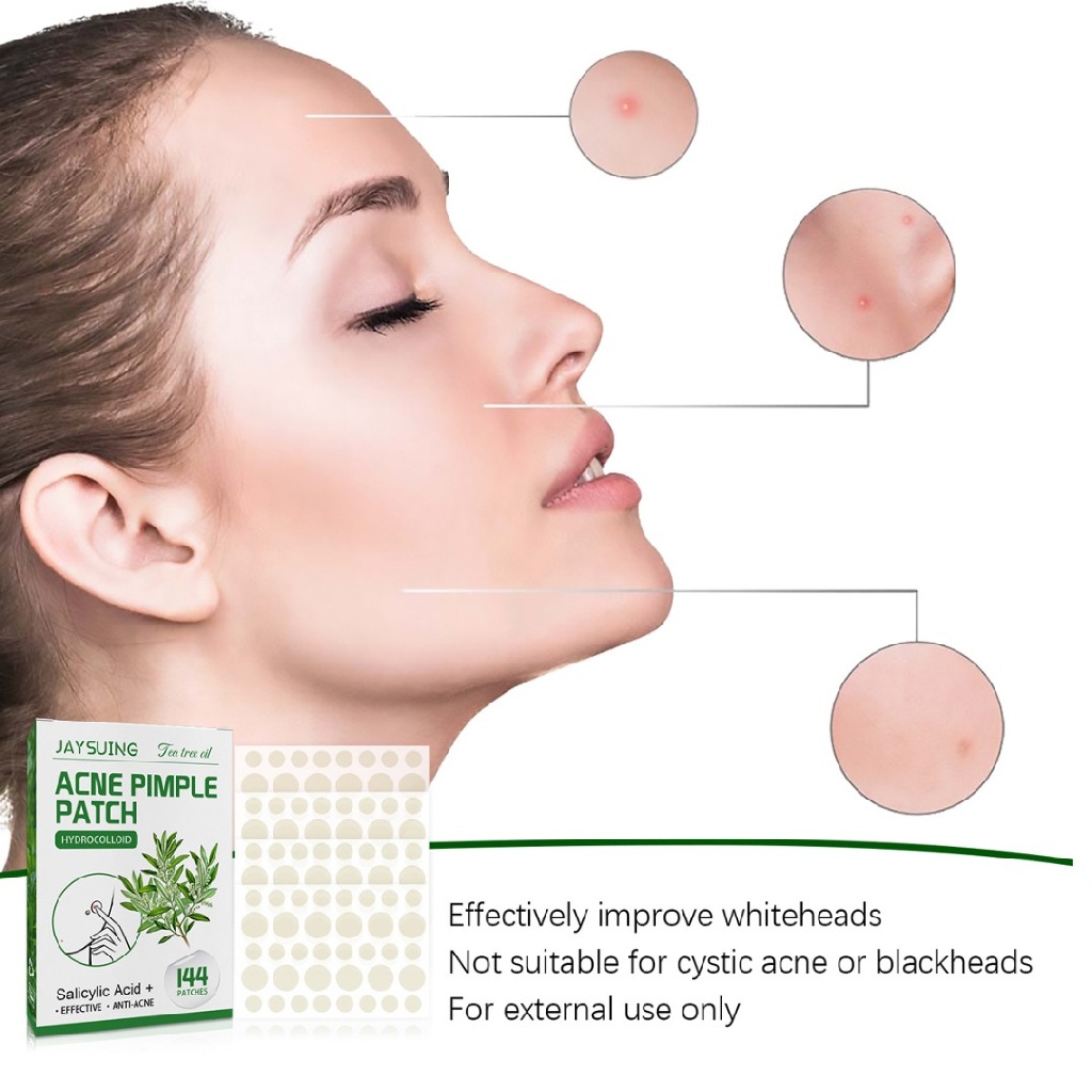 [Hàng mới về] Set 144 miếng dán mụn vô hình siêu mỏng