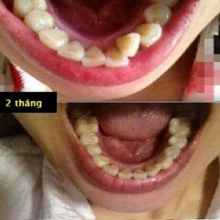 (A1+A2) Dụng cụ niềng răng cho trẻ em