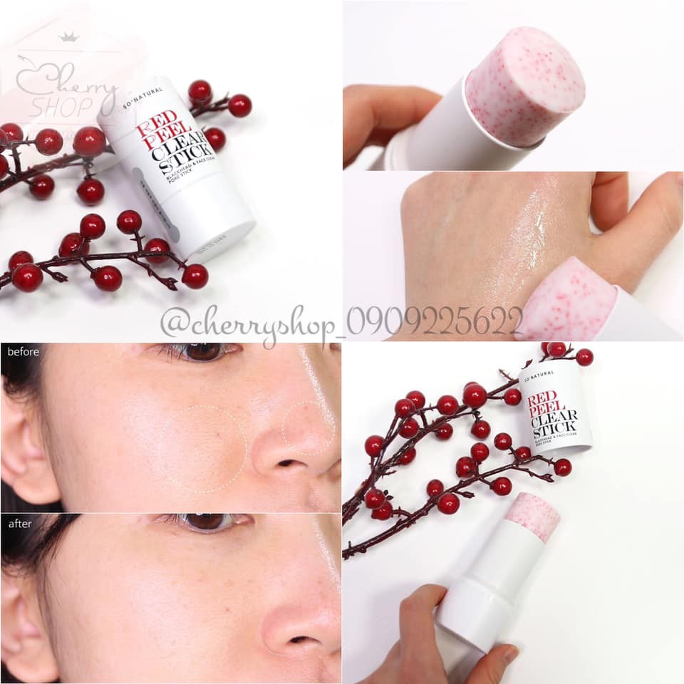 Thanh lăn mụn So’natural Red Peel Clear Stick