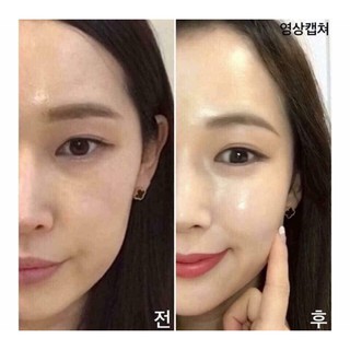 [Tách sét] Chỉ Tơ Căng Da Tự Tiêu CHITOSSIL Thread Lift Ampoule 521