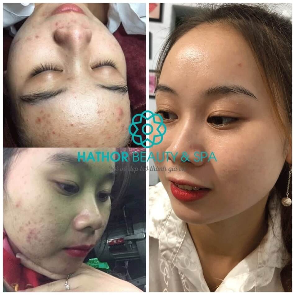 KEM TRỊ MỤN DR. ANTINN CREAM | HATHOR BEAUTY - Góp phần ngăn ngừa và làm mờ các vết thâm, nám, tàn nhang, nếp nhăn