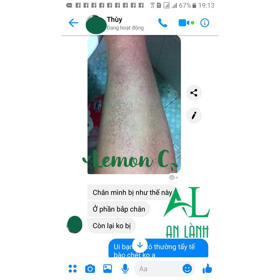Combo viêm nang lông, mụn lưng (mỡ trăn + 3 gói bôt tắm Lemon C) | BigBuy360 - bigbuy360.vn