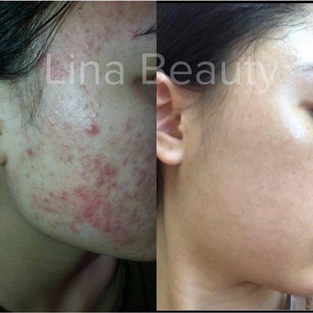 Serum giảm mụn mờ thâm Lina - Công dụng 3 trong 1 hiệu quả