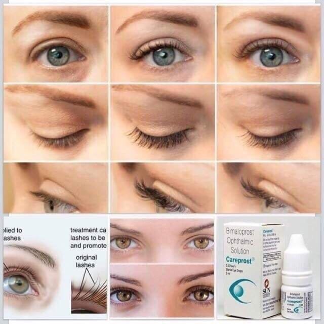 Serum dưỡng và mọc mi careprost ấn độ chính hãng