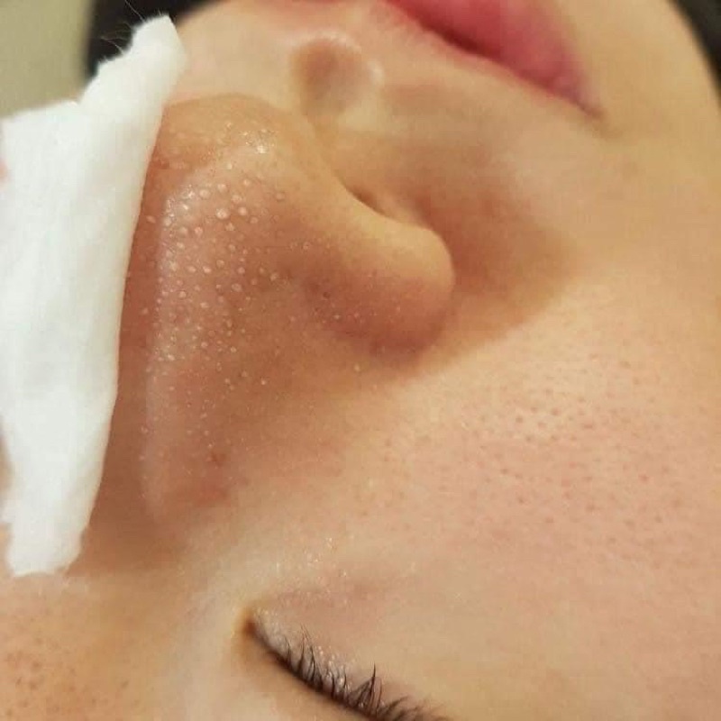 Ủ MỤN LÀM SẠCH MỤN ĐẦU ĐEN SỢI BÃ NHỜN REMOVE BLACKHEAD 60ml
