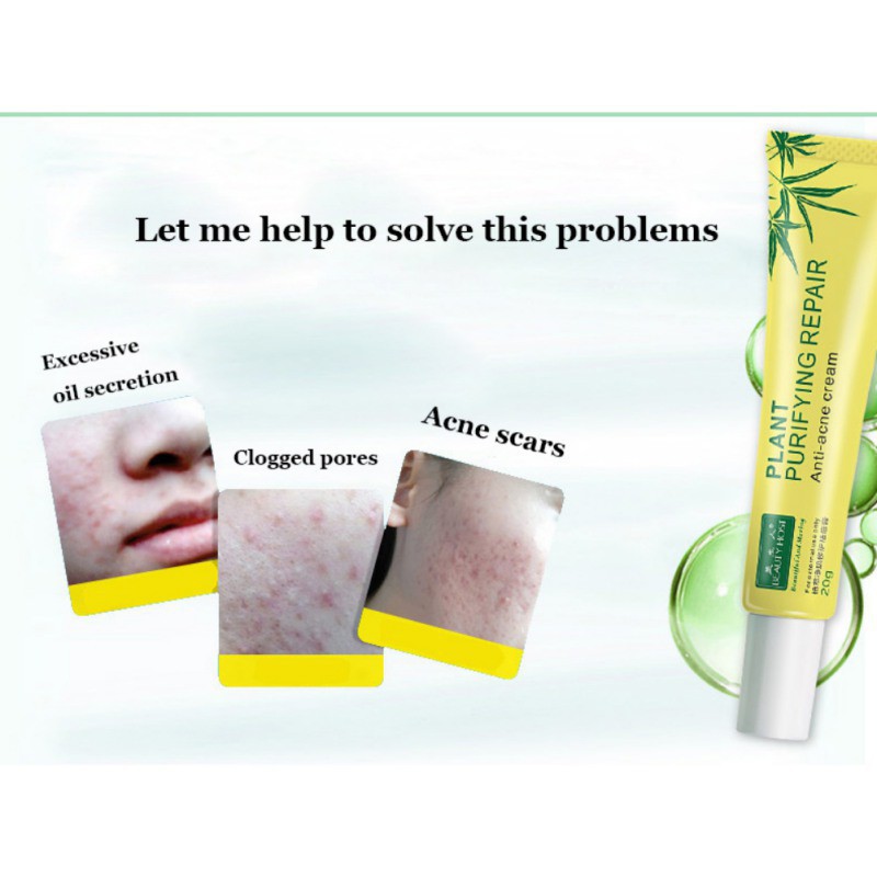 (hàng mới về) kem hỗ trợ giảm sẹo mụn đầu đen dưỡng ẩm 20g | BigBuy360 - bigbuy360.vn