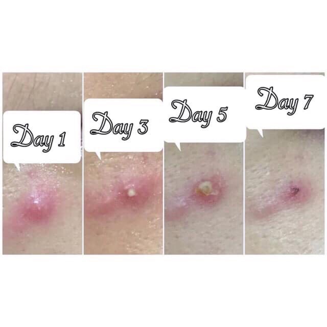 Miếng Dán Mụn Olive Young Careplus