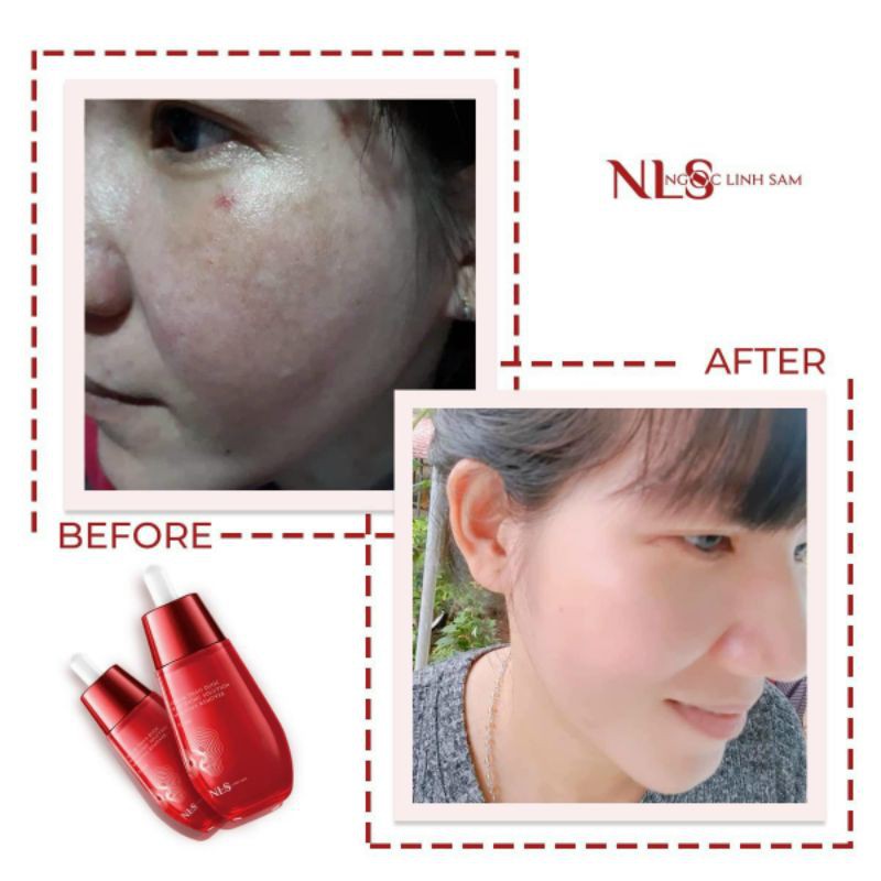 VUA XÓA NÁM, TÀN NHANG, MỤN LINH CHI ĐỎ NGỌC LINH SÂM | BigBuy360 - bigbuy360.vn