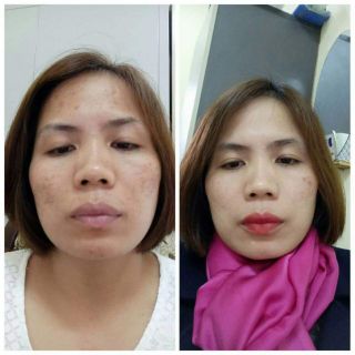 COMBO HỖ TRỢ LÀM GIẢM MỤN LAVOINE