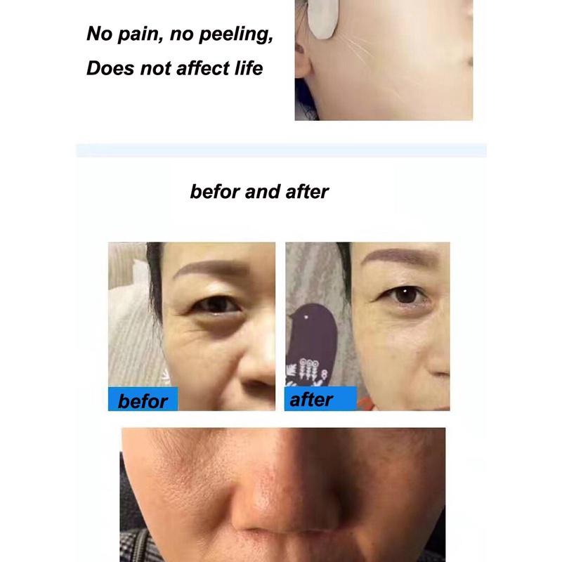 Bút Lăn Kim Protein Làm Săn Chắc Da Mặt Chống Lão Hóa Cải Thiện Nếp Nhăn Và Không Phai Màu