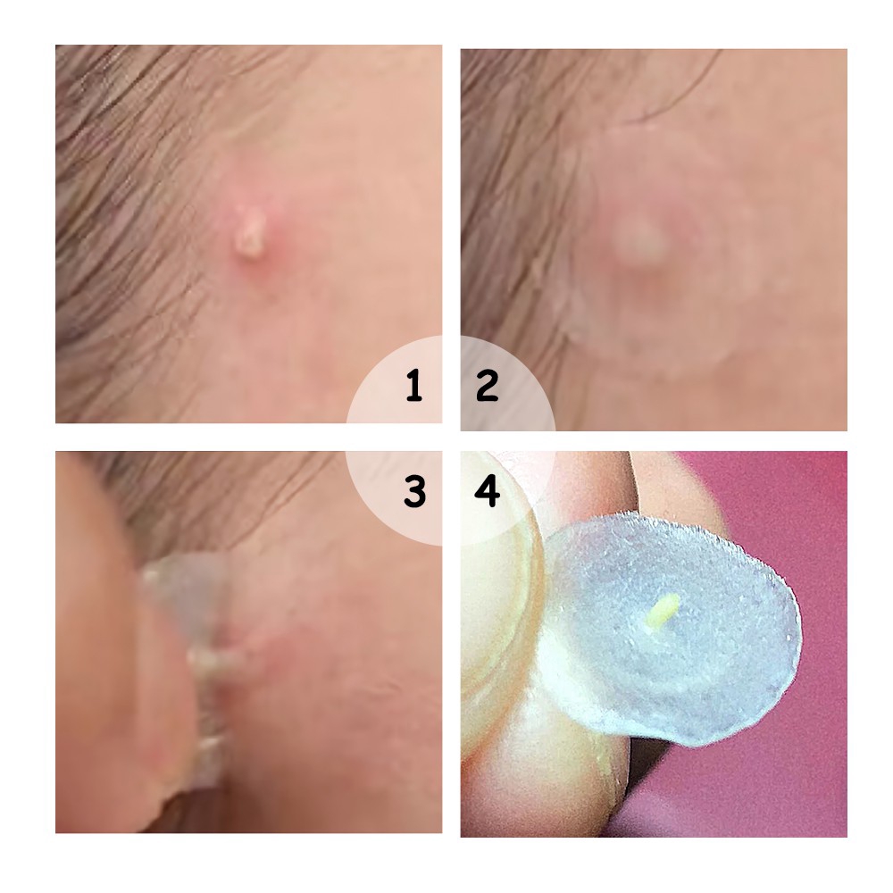 Miếng Dán Hỗ Trợ Giảm Mụn BREYLEE Cao Cấp Chống Thấm Nước Dùng Ban Đêm