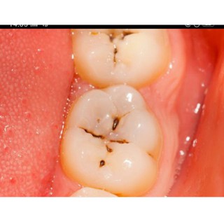 Nước ngậm súc miệng
