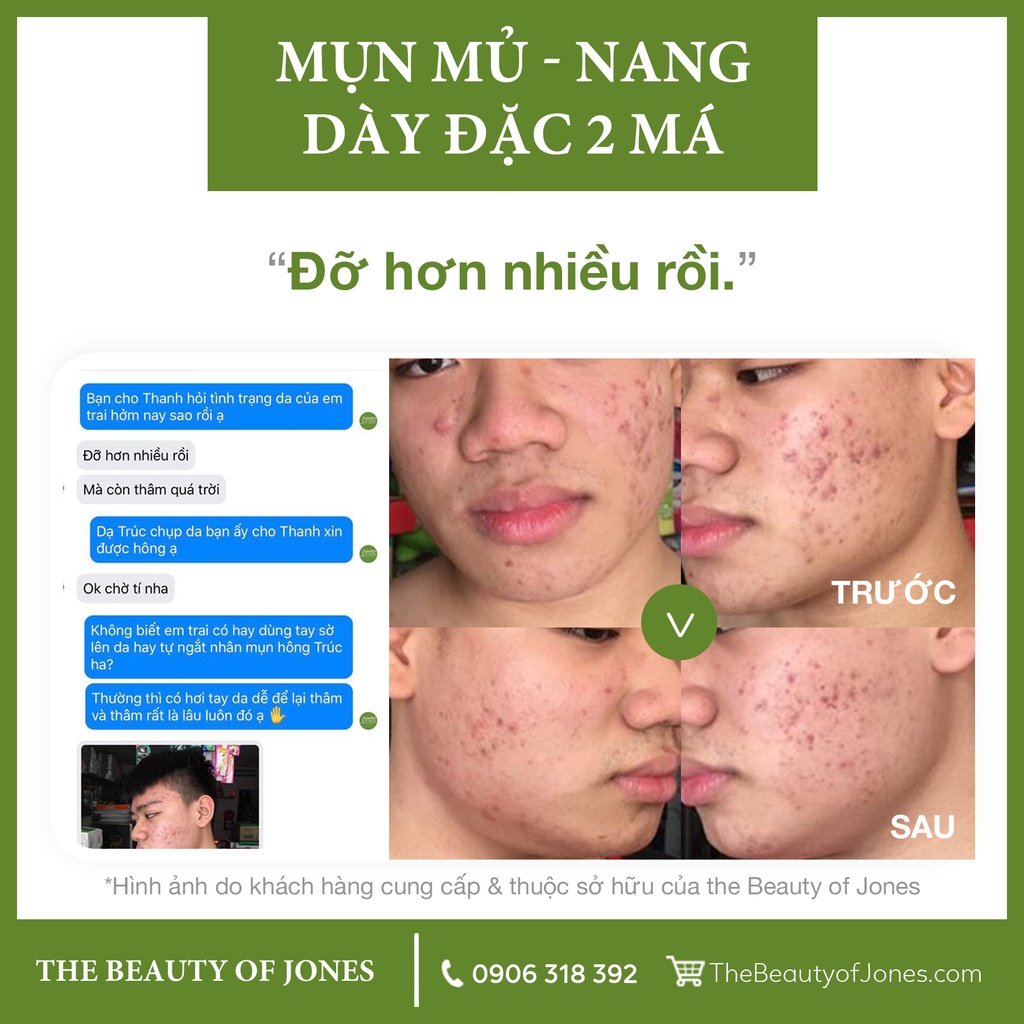 Combo làm sạch và ngừa mụn The Beauty of Jones