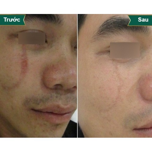 Kem Xóa Sẹo Thâm / Rỗ / Lồi / Lõm Strataderm 10g - Gel Hỗ Trợ Giảm Sẹo Ngăn Ngừa Sẹo Xấu