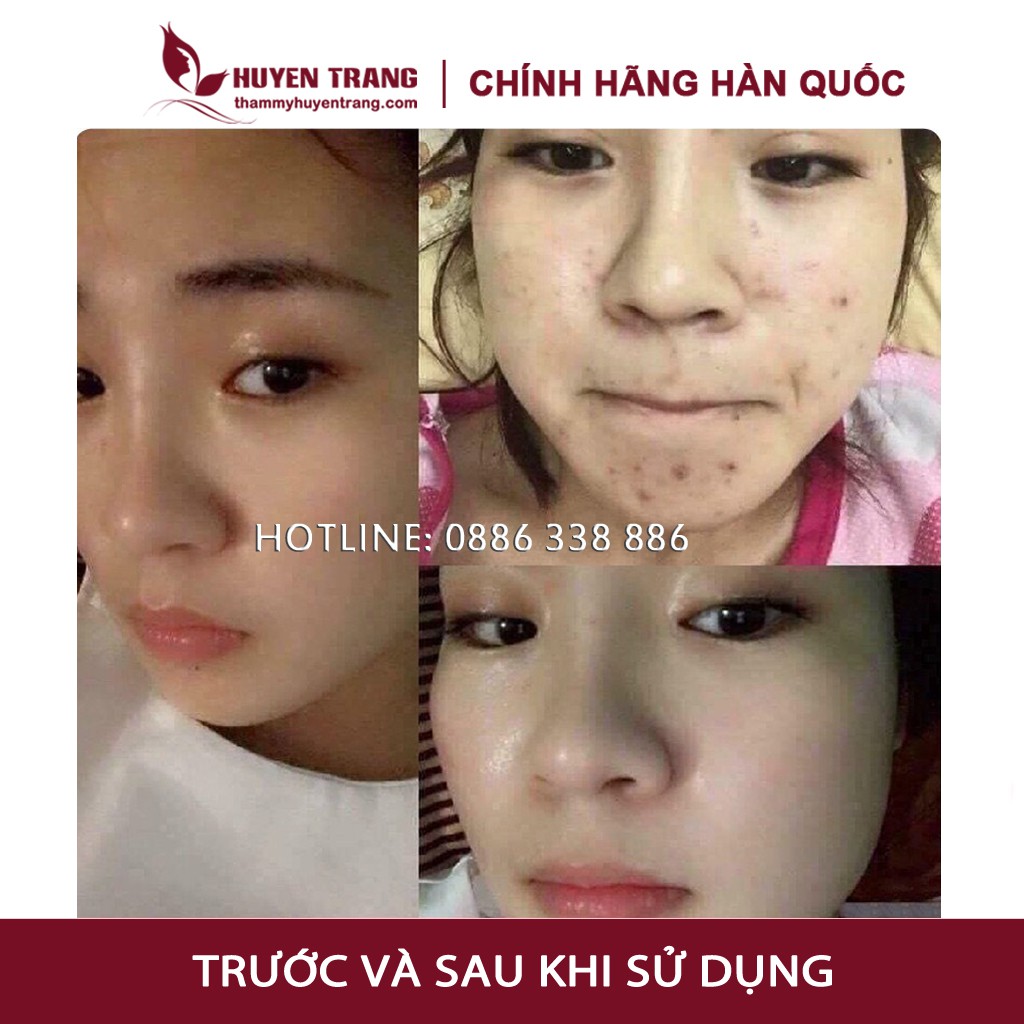 Tế Bào Gốc Hàn Quốc CUTISCURA Mụn, Trắng Da, Trẻ Hóa, Nám Tàn Nhang - Thẩm Mỹ Huyền Trang