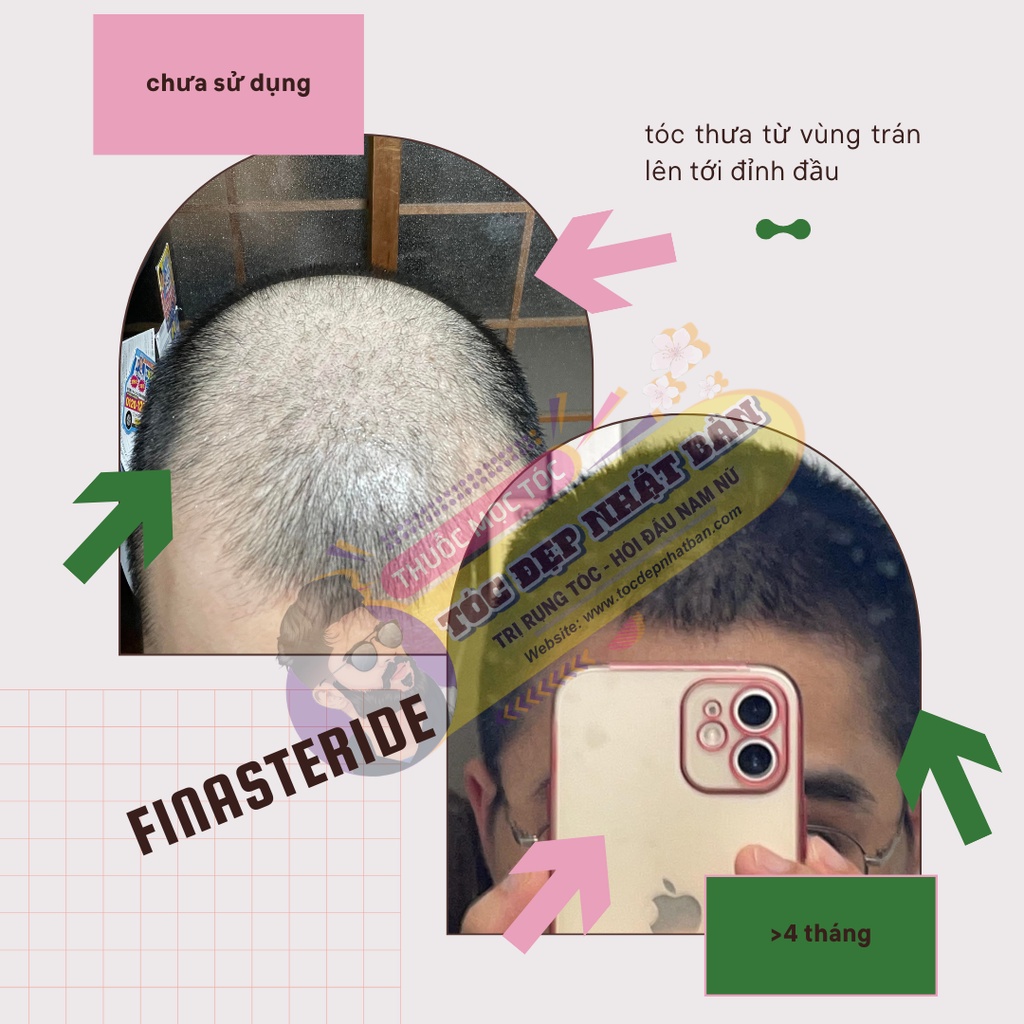 Morr F5 - F10% minoxidil & Finasteride Kích thích mọc tóc cho Nam giới Rụng tóc Di truyền, do tăng DHTi