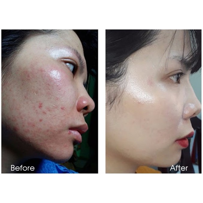 Benzoyl Peroxide: Diệt Khuẩn,Ức Chế Sự Nhân Lên Của Vi Khuẩn C.Acnes