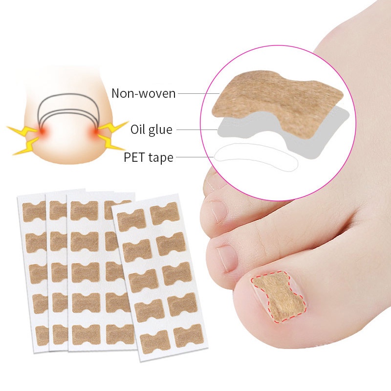 Bộ 50 Miếng Dán Chỉnh Sửa Móng Chân Mọc Ngược