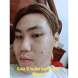 [CHÍNH HÃNG]Serum mụn Detox Blanc