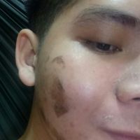 PEEL THAY DA MẶT TCA DÀNH CHO NAM