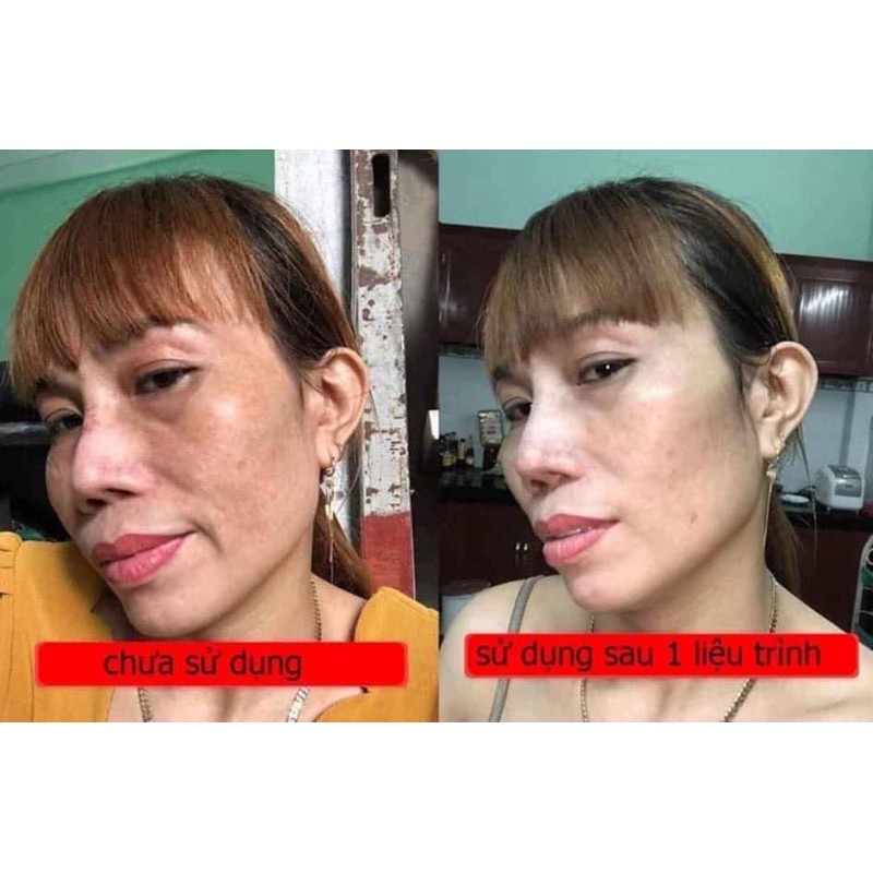 Kem face Collagen nám tàn nhang BN WHITE