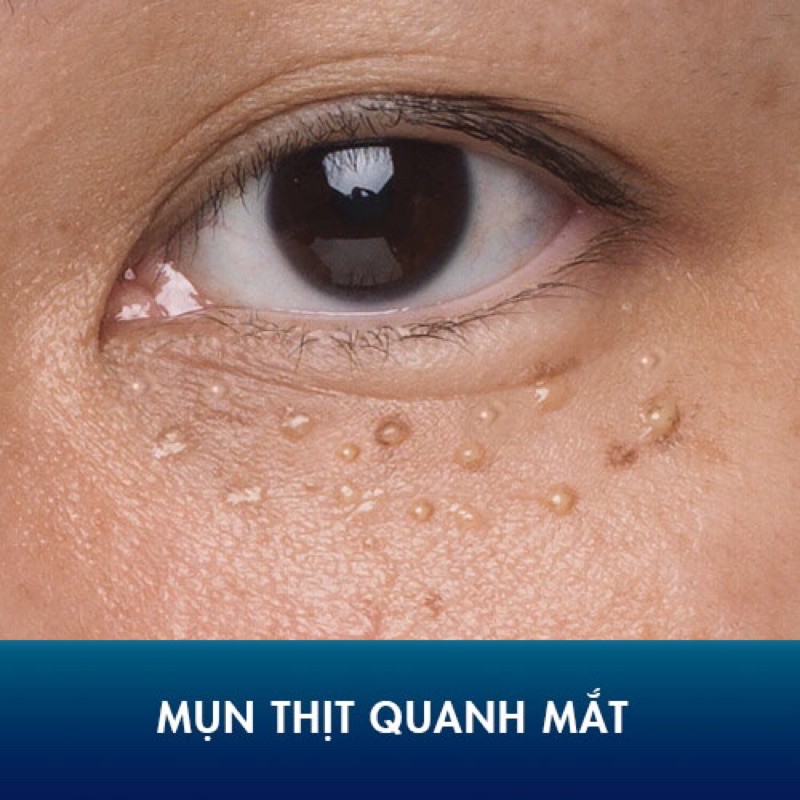 BÚT LÀM MỜ MỤN THỊT VÙNG MẮT TSUBUPORON EYE ESSENCE - TRỊ MỤN THỊT NHẬT BẢN