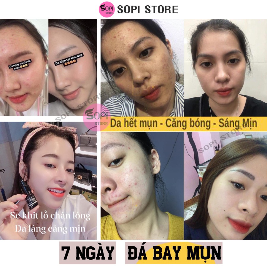 [Mua 3 tặng 1] Serum đường đen Black Sugar Ist Essence 5ml chính hãng, ngừa mụn, xoá thâm mụn, dưỡng da mụn - Sopi Store